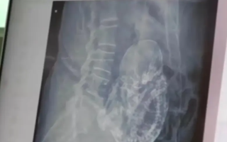 Mujer de 84 años en México con feto petrificado