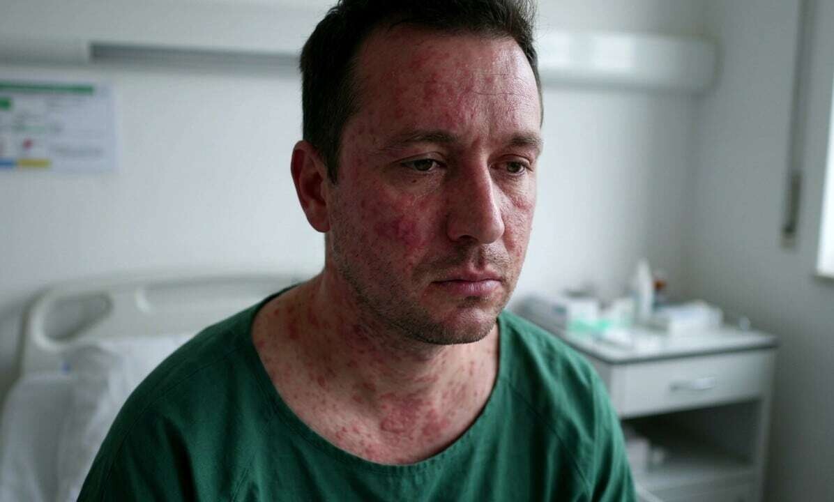 Aumentan casos de sarampión en Nuevo León