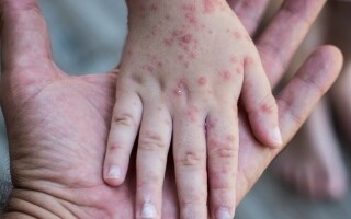 墨西哥因麻疹爆发在瓜达拉哈拉学校强制要求戴口罩