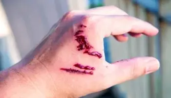 韦拉克鲁斯州发生致命狂犬病病例