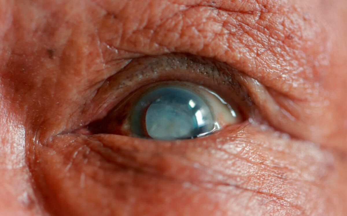 New program 'See for Mexico' for cataract surgeries