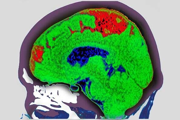 Mexico Approves New Stroke Treatment Method