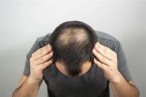 Revolutionary AI Tool for Hair Transplants