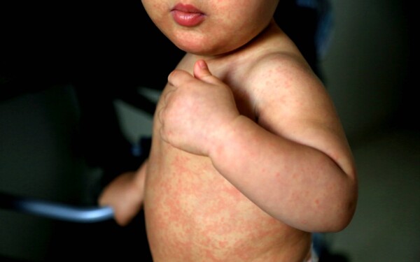 Смерть ребёнка от кори в Тласкале