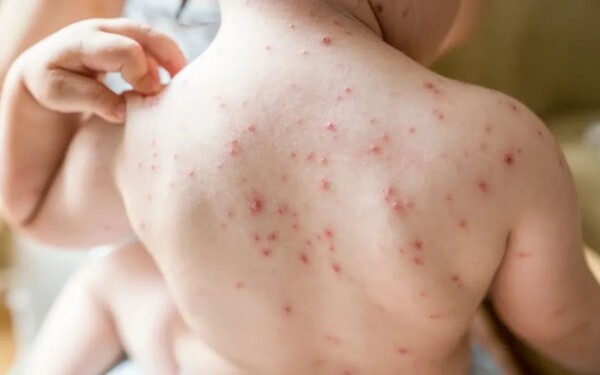 Rising Measles Cases Prompt Health Alert in Mexico